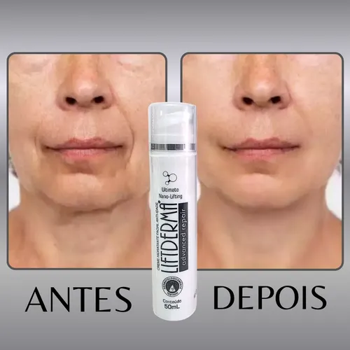 antes e depois liftderma